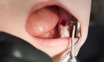 Root Canal Treatment