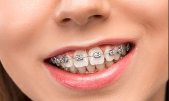 Braces